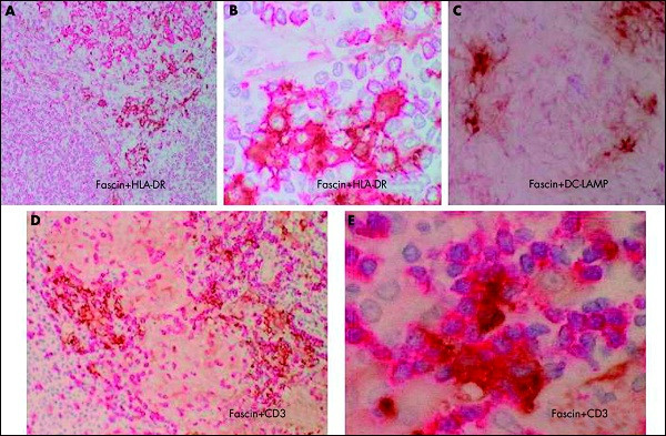 3. Khuẩn gây mụn: Mụn là nỗi ám ảnh kinh niên khi đến tuổi dậy thì, trong đó khuẩn Propionibacterium acnes - một loại khuẩn hình que ẩn dưới da được coi là nguyên nhân chính.