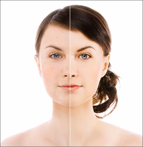 Tuy nhiên, ít ai biết sự có mặt của P.acnes góp phần tạo nên một làn da khỏe mạnh. Chúng tiết ra một loại enzyme có tác dụng phá vỡ chất béo trong bã nhờn, nhờ thế chất nhờn trên mặt sẽ giống như một loại chất dưỡng ẩm. Ngoài ra, khuẩn P.acnes còn gia tăng tính axit trên da nhằm giảm nguy cơ nhiễm những khuẩn nguy hiểm hơn như tụ cầu vàng (staphylococcus aureus) hoặc liên cầu khuẩn Streptococcus pyogenes (khuẩn ăn thịt).