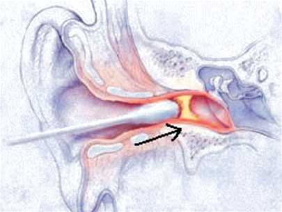 Tăm bông vô tình đẩy sau ráy tai vào bên trong (Ảnh: Internet) Tăm bông vô tình đẩy sau ráy tai vào bên trong (Ảnh: Internet)