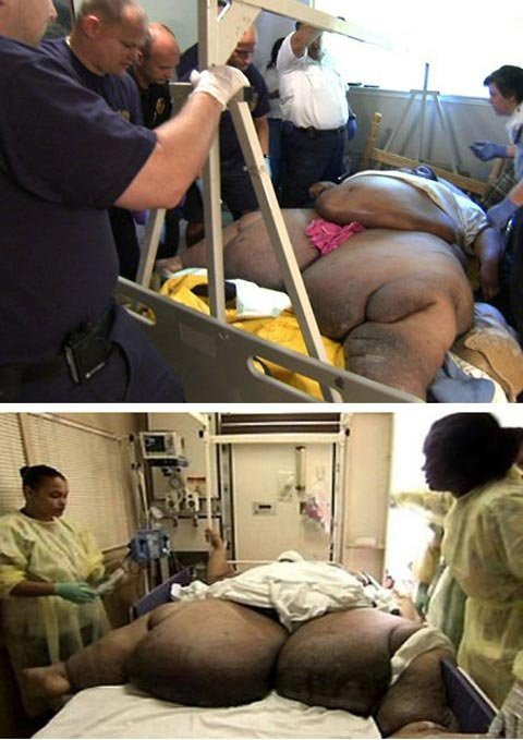 5. Kenneth Brumley: Kenneth Brumley là một trong những người nặng cân nhất từng được ghi nhận trên thế giới. Ông từng được khắc họa trong một bộ phim tài liệu của chương trình BodyShock trên kênh Channel 4 nhưng “Người cha nửa tấn” của 4 đứa con, với trọng lượng cơ thể chính xác là 468kg. Tại bệnh viện Renaissance, Brumley được nhóm chuyên gia đang chữa trị cho Renee Williams – người phụ nữ nặng nhất thế giới vào thời điểm đó, giúp giảm cân. Bước đầu tiên trong việc chữa trị cho Brumley là một chế độ ăn kiêng nghiêm ngặt chỉ có 1.200 calo mỗi ngày, nhờ đó ông xuống được 76kg chỉ trong 40 ngày. Xem thêm: Lạ lùng người phụ nữ khóc ra 'kim cương' / Trẻ béo phì dễ mắc ung thư gan khi trưởng thành / Bệnh lạ: Cô gái sau hôn mê bỗng trở thành... người đồng tính 5. Kenneth Brumley: Kenneth Brumley là một trong những người nặng cân nhất từng được ghi nhận trên thế giới. Ông từng được khắc họa trong một bộ phim tài liệu của chương trình BodyShock trên kênh Channel 4 nhưng “Người cha nửa tấn” của 4 đứa con, với trọng lượng cơ thể chính xác là 468kg. Tại bệnh viện Renaissance, Brumley được nhóm chuyên gia đang chữa trị cho Renee Williams – người phụ nữ nặng nhất thế giới vào thời điểm đó, giúp giảm cân. Bước đầu tiên trong việc chữa trị cho Brumley là một chế độ ăn kiêng nghiêm ngặt chỉ có 1.200 calo mỗi ngày, nhờ đó ông xuống được 76kg chỉ trong 40 ngày. Xem thêm: Lạ lùng người phụ nữ khóc ra 'kim cương' / Trẻ béo phì dễ mắc ung thư gan khi trưởng thành / Bệnh lạ: Cô gái sau hôn mê bỗng trở thành... người đồng tính