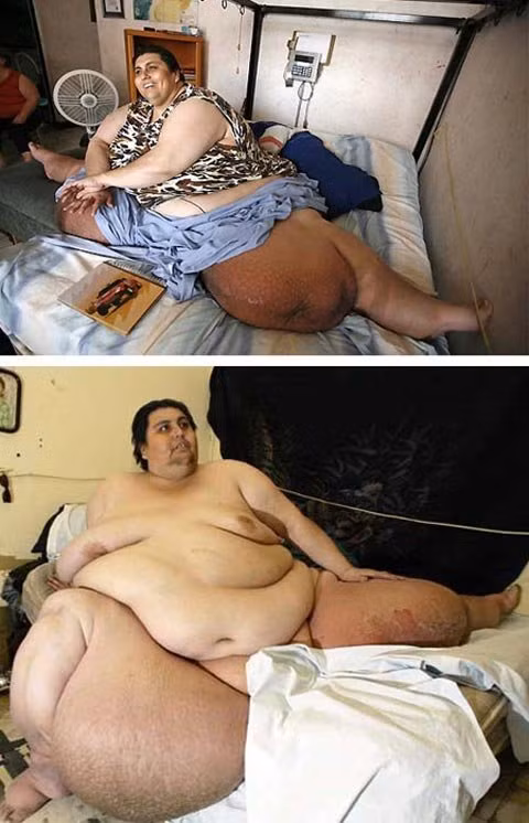 3. Manuel Uribe: Manuel Uribe (sinh ngày 11/6/1965), đến từ Monterrey, Nuevo León, Mexico nổi tiếng trong lịch sử thế giới vì … béo bệnh. Sau khi đạt tới trọng lượng tối đa khoảng 597kg và không thể rời khỏi giường của mình kể từ năm 2001, Uribe đã giảm gần 181kg (gần 1/3 trọng lượng cơ thể) với sự giúp đỡ của các bác sĩ và chuyên gia dinh dưỡng cũng như việc thực hiệm nghiêm ngặt chế độ ăn kiêng Zone. Uribe thu hút sự chú ý của dư luận khắp thế giới khi xuất hiện trên kênh truyền hình Televisa vào tháng 1/2006, nhưng từ chối các đề nghị tài trợ cho phẫu thuật dạ dày giảm cân ở Italia. Xem thêm: Lạ lùng người phụ nữ khóc ra 'kim cương' / Trẻ béo phì dễ mắc ung thư gan khi trưởng thành / Bệnh lạ: Cô gái sau hôn mê bỗng trở thành... người đồng tính 3. Manuel Uribe: Manuel Uribe (sinh ngày 11/6/1965), đến từ Monterrey, Nuevo León, Mexico nổi tiếng trong lịch sử thế giới vì … béo bệnh. Sau khi đạt tới trọng lượng tối đa khoảng 597kg và không thể rời khỏi giường của mình kể từ năm 2001, Uribe đã giảm gần 181kg (gần 1/3 trọng lượng cơ thể) với sự giúp đỡ của các bác sĩ và chuyên gia dinh dưỡng cũng như việc thực hiệm nghiêm ngặt chế độ ăn kiêng Zone. Uribe thu hút sự chú ý của dư luận khắp thế giới khi xuất hiện trên kênh truyền hình Televisa vào tháng 1/2006, nhưng từ chối các đề nghị tài trợ cho phẫu thuật dạ dày giảm cân ở Italia. Xem thêm: Lạ lùng người phụ nữ khóc ra 'kim cương' / Trẻ béo phì dễ mắc ung thư gan khi trưởng thành / Bệnh lạ: Cô gái sau hôn mê bỗng trở thành... người đồng tính