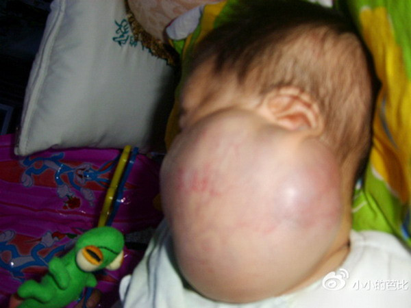 Từ khi mới chào đời cho tới nay, khối u này không ngừng tăng kích cỡ. Xem thêm: Hình ảnh về những căn bệnh quái dị nhất trên thế giới (P4) / Hình ảnh về những căn bệnh quái dị nhất trên thế giới (P1)