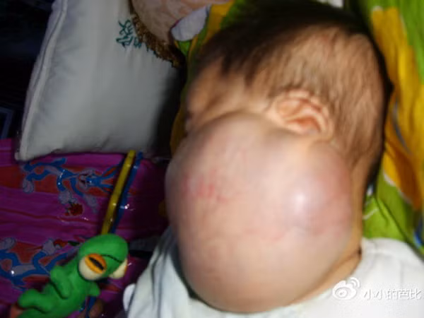 Từ khi mới chào đời cho tới nay, khối u này không ngừng tăng kích cỡ. Xem thêm: Hình ảnh về những căn bệnh quái dị nhất trên thế giới (P4) / Hình ảnh về những căn bệnh quái dị nhất trên thế giới (P1)