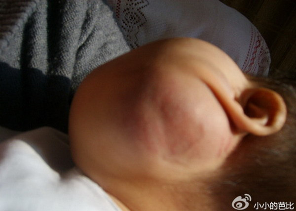 Cận cảnh khối u cực lớn trên má trái của Tiểu Miễn. Xem thêm: Hình ảnh về những căn bệnh quái dị nhất trên thế giới (P4) / Hình ảnh về những căn bệnh quái dị nhất trên thế giới (P1)