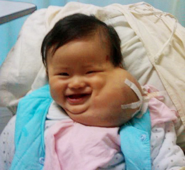 Ban đầu, khối u có kích thước nhỏ như quả táo, cho tới nay, khi bé Tiểu Miễn 8 tháng tuổi thì khối u đã lớn gần bằng cả khuôn mặt. Nó đã làm ảnh hưởng nghiêm trọng tới cuộc sống của Tiểu Miễn và cả gia đình bé. Xem thêm: Hình ảnh về những căn bệnh quái dị nhất trên thế giới (P4) / Hình ảnh về những căn bệnh quái dị nhất trên thế giới (P1)