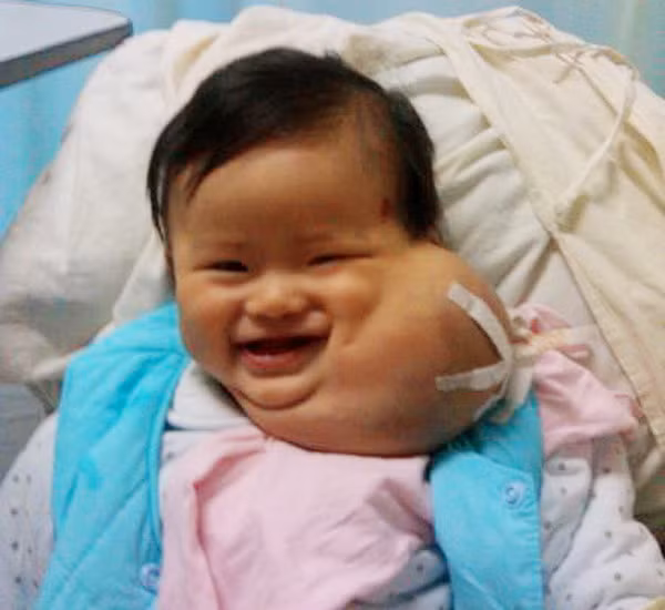 Ban đầu, khối u có kích thước nhỏ như quả táo, cho tới nay, khi bé Tiểu Miễn 8 tháng tuổi thì khối u đã lớn gần bằng cả khuôn mặt. Nó đã làm ảnh hưởng nghiêm trọng tới cuộc sống của Tiểu Miễn và cả gia đình bé. Xem thêm: Hình ảnh về những căn bệnh quái dị nhất trên thế giới (P4) / Hình ảnh về những căn bệnh quái dị nhất trên thế giới (P1)