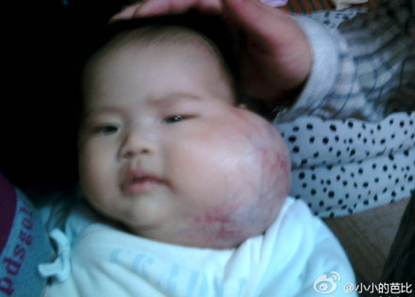 Vì sự phức tạp trong cấu tạo nên các bác sỹ và người thân của Tiểu Miễn đều rất do dự trước khi quyết định phẫu thuật cắt bỏ. Hiện tại, bé Tiểu Miễn đang được theo dõi và tiến hành các cuộc kiểm tra, xét nghiệm để gửi hồ sơ lên bệnh viện trung ương. Xem thêm: Hình ảnh về những căn bệnh quái dị nhất trên thế giới (P4) / Hình ảnh về những căn bệnh quái dị nhất trên thế giới (P1)