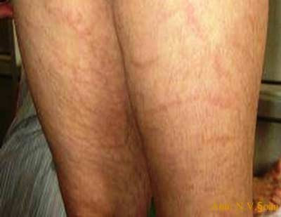 Rạn da sau uống thuốc Nam có chứa corticoid. Xem thêm: Những cặp sinh đôi dính liền kỳ lạ nhất thế giới.