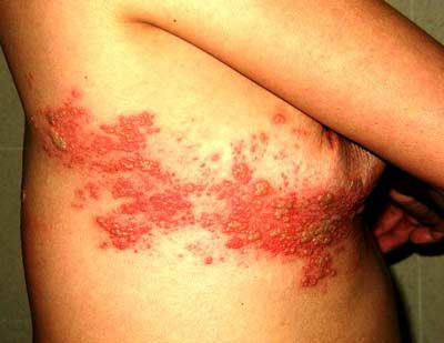 Bệnh nhân Nguyễn Thị Th (29 tuổi) bị zona (giời leo) nhiều lần sau dùng corticoid. Bệnh nhân bị lupus ban đỏ hệ thống đã vào viện 3 lần, tự uống và tiêm nhiều loại corticoid trong vòng 5 năm. Xem thêm: Những cặp sinh đôi dính liền kỳ lạ nhất thế giới.