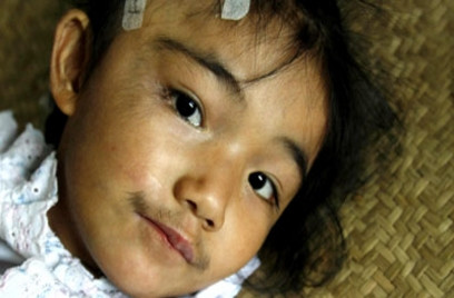 Corticoid (hay còn gọi là glucocorticoid) là nhóm thuốc có gốc steroid với tác dụng chống viêm mạnh, chống dị ứng và ức chế miễn dịch. Tuy nhiên, sử dụng loại thuốc này chẳng khác nào “con dao 2 lưỡi”, không ít người đã gánh hậu quả đáng tiếc. Xem thêm: Những cặp sinh đôi dính liền kỳ lạ nhất thế giới.