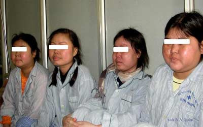 Hội chứng giả Cushing (suy vỏ thượng thận) do corticoid trong quá trình điều trị bệnh. Xem thêm: Những cặp sinh đôi dính liền kỳ lạ nhất thế giới.