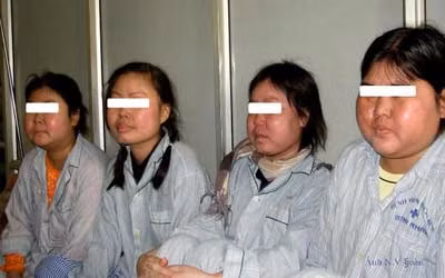 Hội chứng giả Cushing (suy vỏ thượng thận) do corticoid trong quá trình điều trị bệnh. Xem thêm: Những cặp sinh đôi dính liền kỳ lạ nhất thế giới.