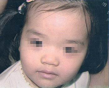 Theo PGS.TS Nguyễn Văn Đoàn, GĐ Trung tâm dị ứng miễn dịch lâm sàng. BV Bạch Mai, dùng corticoid có thể gặp một số tác dụng phụ như loét đường tiêu hóa, rối loạn nước và điện giải, cao huyết áp, loãng xương… Vì vậy, dùng thuốc này đặc biệt phải theo chỉ định của thầy thuốc, không tự ý dùng thuốc, kể cả thuốc bôi ngoài da. Xem thêm: Những cặp sinh đôi dính liền kỳ lạ nhất thế giới.