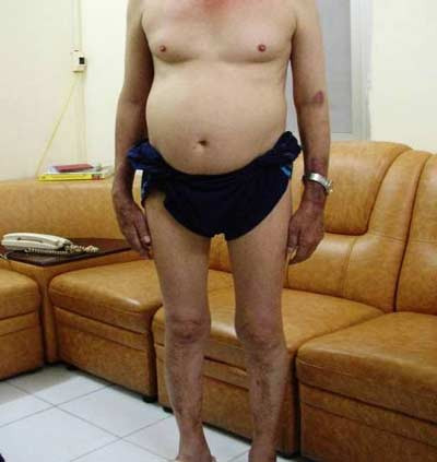 Hội chứng giả Cushing do corticoid ở bệnh nhân nam. Xem thêm: Những cặp sinh đôi dính liền kỳ lạ nhất thế giới.