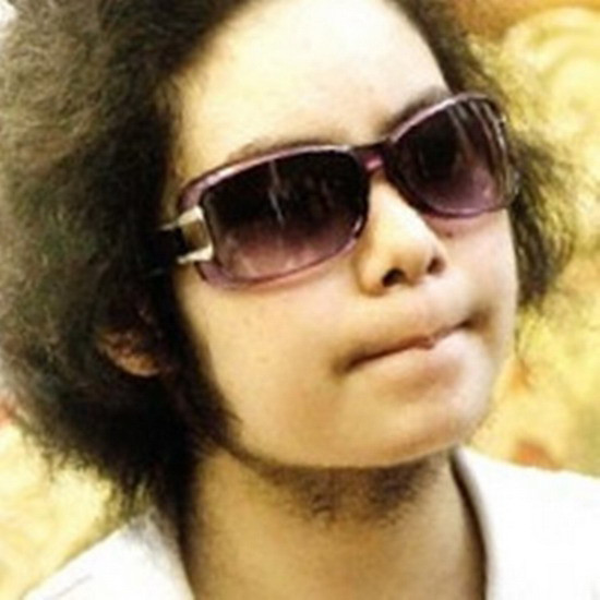 Trung tâm dị ứng miễn dịch lâm sàng, BV Bạch Mai thường xuyên tiếp nhận những ca bệnh là hệ quả của việc sử dụng thuốc corticoid không đúng cách. Xem thêm: Những cặp sinh đôi dính liền kỳ lạ nhất thế giới.