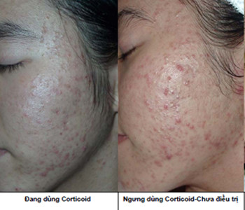 Ngoài ra, corticoid chống chỉ định với bệnh nhân nhiễm nấm toàn thân và quá mẫn cảm với thuốc. Đặc biệt chú ý sử dụng thận trọng khi thật cần thiết đối với phụ nữ mang thai và cho con bú vì thuốc có thể truyền qua nhau thai và bài tiết qua sữa. Xem thêm: Những cặp sinh đôi dính liền kỳ lạ nhất thế giới.