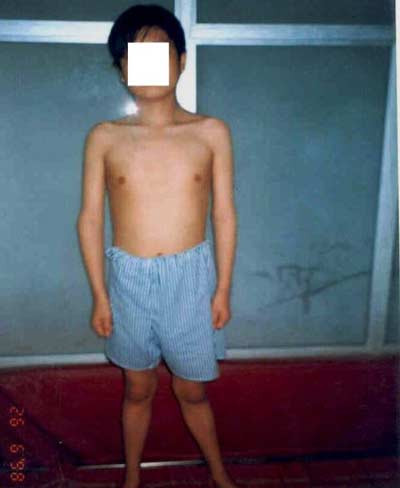 Chậm phát triển do corticoid. BN 18 tuổi chỉ nặng 31kg, cao 1,35m. (Lê Phương (TH từ Internet/Lao động)) Xem thêm: Những cặp sinh đôi dính liền kỳ lạ nhất thế giới.