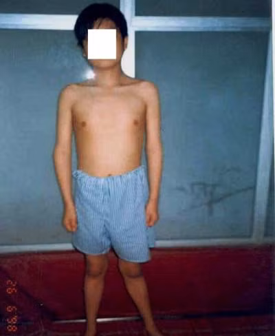 Chậm phát triển do corticoid. BN 18 tuổi chỉ nặng 31kg, cao 1,35m. (Lê Phương (TH từ Internet/Lao động)) Xem thêm: Những cặp sinh đôi dính liền kỳ lạ nhất thế giới.