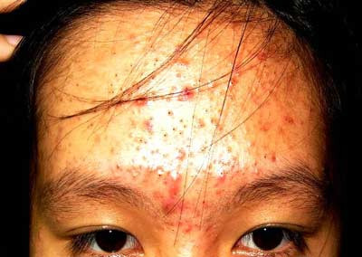 Trứng cá sau bôi corticoid tại chỗ. Xem thêm: Những cặp sinh đôi dính liền kỳ lạ nhất thế giới.