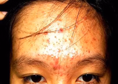 Trứng cá sau bôi corticoid tại chỗ. Xem thêm: Những cặp sinh đôi dính liền kỳ lạ nhất thế giới.