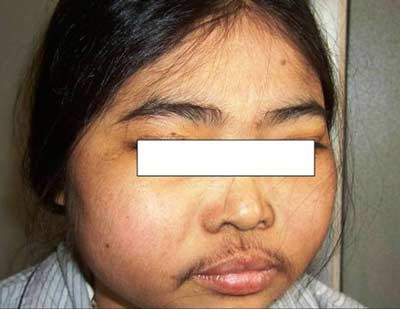 Mọc ria như nam giới và mất kinh nguyệt sau dùng thuốc corticoid. Xem thêm: Những cặp sinh đôi dính liền kỳ lạ nhất thế giới.