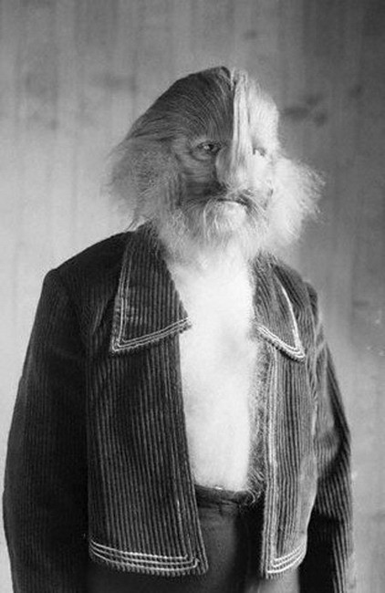 Stephan Bibrowski: Stephan Bibrowski (1891-1932) là một nghệ sĩ nổi tiếng được biết đến với cái tên "người đàn ông với khuôn mặt sư tử". Toàn bộ cơ thể của ông được bao phủ bởi lông khiến ông có hình dạng giống như một con sư tử. Bibrowski sinh ra tại Warsaw, Ba Lan. Mẹ của ông cho rằng do bà thường xuyên phải chịu đựng thái độ hung dữ như sư tử của cha ông khi mang thai nên mới sinh ra Bibrowski với hình dáng như vậy. Xem thêm: Phát hoảng với những thân hình "khủng" nhất thế giới do ăn nhiều / Những hình ảnh thương tâm về căn bệnh 'lạ' ở Quảng Ngãi Stephan Bibrowski: Stephan Bibrowski (1891-1932) là một nghệ sĩ nổi tiếng được biết đến với cái tên "người đàn ông với khuôn mặt sư tử". Toàn bộ cơ thể của ông được bao phủ bởi lông khiến ông có hình dạng giống như một con sư tử. Bibrowski sinh ra tại Warsaw, Ba Lan. Mẹ của ông cho rằng do bà thường xuyên phải chịu đựng thái độ hung dữ như sư tử của cha ông khi mang thai nên mới sinh ra Bibrowski với hình dáng như vậy. Xem thêm: Phát hoảng với những thân hình "khủng" nhất thế giới do ăn nhiều / Những hình ảnh thương tâm về căn bệnh 'lạ' ở Quảng Ngãi