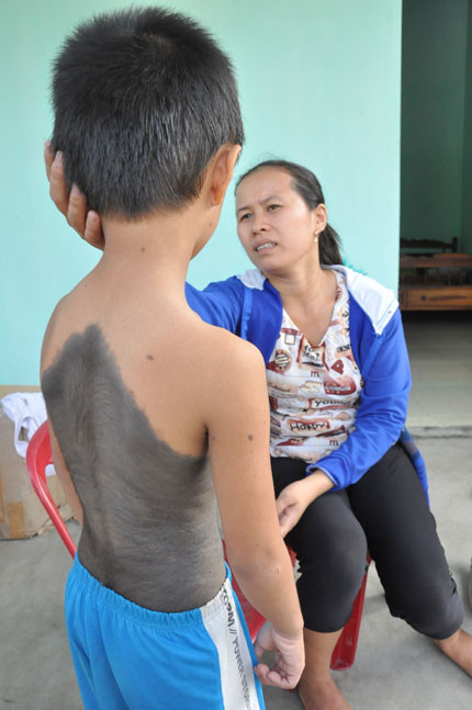 Cháu Nguyễn Văn Phong (Việt Nam) bị mắc chứng bệnh “người sói” và chứng bệnh “bớt tăng sắc tố”. Xem thêm: Phát hoảng với những thân hình "khủng" nhất thế giới do ăn nhiều / Những hình ảnh thương tâm về căn bệnh 'lạ' ở Quảng Ngãi Cháu Nguyễn Văn Phong (Việt Nam) bị mắc chứng bệnh “người sói” và chứng bệnh “bớt tăng sắc tố”. Xem thêm: Phát hoảng với những thân hình "khủng" nhất thế giới do ăn nhiều / Những hình ảnh thương tâm về căn bệnh 'lạ' ở Quảng Ngãi