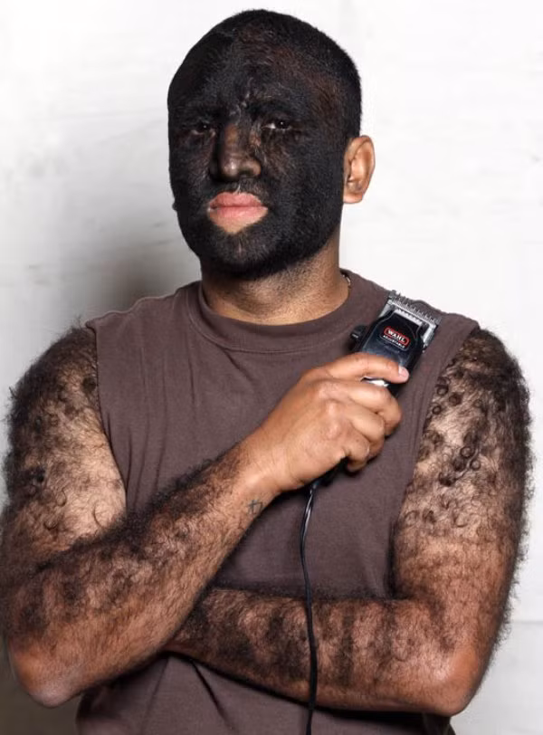 Larry Gomez, 35 tuổi, toàn thân và mặt lông đen phủ kín Xem thêm: Phát hoảng với những thân hình "khủng" nhất thế giới do ăn nhiều / Những hình ảnh thương tâm về căn bệnh 'lạ' ở Quảng Ngãi