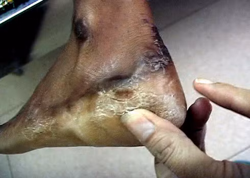 Nhưng kèm theo đó và nguy hiểm hơn, bệnh còn gây các hội chứng dạ dày, tắc mật, hủy hoại tế bào gan. Có khoảng 10% bệnh nhân bị rối loạn chức năng gan nặng và được đưa đến các bệnh viện đa khoa tỉnh, huyện để cấp cứu và điều trị tích cực. Xem thêm: Phát hoảng với những thân hình "khủng" nhất thế giới do ăn nhiều / 11 loại thảo dược dễ tìm giúp bạn có hơi thở thơm tho