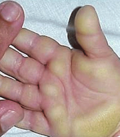 Mới đây nhất, tại cuộc họp khẩn cấp chiều 20/4 tại Bộ Y tế về “bệnh lạ” ở Quãng Ngãi, Hội đồng khoa học của Bộ đã thống nhất lại phác đồ điều trị bệnh lần thứ 2 sửa đổi, hướng dẫn chi tiết hơn trong việc điều trị, phân cấp cụ thể mức độ bệnh để phân tuyến điều trị. Các chuyên gia y tế cũng thống nhất gọi tên bệnh là “hội chứng viêm dày sừng da bàn tay, bàn chân” thay tên gọi cũ là “bệnh viêm lòng bàn tay, bàn chân và có rối loạn chức năng gan”. Xem thêm: Phát hoảng với những thân hình "khủng" nhất thế giới do ăn nhiều / 11 loại thảo dược dễ tìm giúp bạn có hơi thở thơm tho Mới đây nhất, tại cuộc họp khẩn cấp chiều 20/4 tại Bộ Y tế về “bệnh lạ” ở Quãng Ngãi, Hội đồng khoa học của Bộ đã thống nhất lại phác đồ điều trị bệnh lần thứ 2 sửa đổi, hướng dẫn chi tiết hơn trong việc điều trị, phân cấp cụ thể mức độ bệnh để phân tuyến điều trị. Các chuyên gia y tế cũng thống nhất gọi tên bệnh là “hội chứng viêm dày sừng da bàn tay, bàn chân” thay tên gọi cũ là “bệnh viêm lòng bàn tay, bàn chân và có rối loạn chức năng gan”. Xem thêm: Phát hoảng với những thân hình "khủng" nhất thế giới do ăn nhiều / 11 loại thảo dược dễ tìm giúp bạn có hơi thở thơm tho