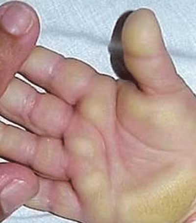 Mới đây nhất, tại cuộc họp khẩn cấp chiều 20/4 tại Bộ Y tế về “bệnh lạ” ở Quãng Ngãi, Hội đồng khoa học của Bộ đã thống nhất lại phác đồ điều trị bệnh lần thứ 2 sửa đổi, hướng dẫn chi tiết hơn trong việc điều trị, phân cấp cụ thể mức độ bệnh để phân tuyến điều trị. Các chuyên gia y tế cũng thống nhất gọi tên bệnh là “hội chứng viêm dày sừng da bàn tay, bàn chân” thay tên gọi cũ là “bệnh viêm lòng bàn tay, bàn chân và có rối loạn chức năng gan”. Xem thêm: Phát hoảng với những thân hình "khủng" nhất thế giới do ăn nhiều / 11 loại thảo dược dễ tìm giúp bạn có hơi thở thơm tho