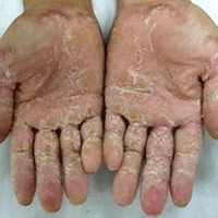 Theo các chuyên gia phòng chống độc của Việt Nam, để tìm ra nguyên nhân thì việc cần làm bây giờ là tìm hiểu tiền sử, quá trình tiếp xúc của người bệnh, còn việc tìm các hóa chất gây độc là rất khó. Xem thêm: Phát hoảng với những thân hình "khủng" nhất thế giới do ăn nhiều / 11 loại thảo dược dễ tìm giúp bạn có hơi thở thơm tho Theo các chuyên gia phòng chống độc của Việt Nam, để tìm ra nguyên nhân thì việc cần làm bây giờ là tìm hiểu tiền sử, quá trình tiếp xúc của người bệnh, còn việc tìm các hóa chất gây độc là rất khó. Xem thêm: Phát hoảng với những thân hình "khủng" nhất thế giới do ăn nhiều / 11 loại thảo dược dễ tìm giúp bạn có hơi thở thơm tho