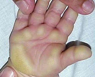 Căn bệnh lạ này lần đầu tiên được phát hiện vào tháng 4 năm ngoái, tuy nhiên những trường hợp tử vong đầu tiên được ghi nhận vào tháng 10 cùng năm. Kể từ đầu tháng trước tới nay, ít nhất 68 người khác đã bị nhiễm bệnh, với 8 ca tử vong. Xem thêm: Phát hoảng với những thân hình "khủng" nhất thế giới do ăn nhiều / 11 loại thảo dược dễ tìm giúp bạn có hơi thở thơm tho Căn bệnh lạ này lần đầu tiên được phát hiện vào tháng 4 năm ngoái, tuy nhiên những trường hợp tử vong đầu tiên được ghi nhận vào tháng 10 cùng năm. Kể từ đầu tháng trước tới nay, ít nhất 68 người khác đã bị nhiễm bệnh, với 8 ca tử vong. Xem thêm: Phát hoảng với những thân hình "khủng" nhất thế giới do ăn nhiều / 11 loại thảo dược dễ tìm giúp bạn có hơi thở thơm tho