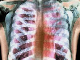 Nguyên nhân gây bệnh chủ yếu do vi khuẩn lao ở người gây ra. Lao xương khớp thường xuất hiện sau lao sơ nhiễm 2-3 năm (giai đoạn 2 theo Ranke). Hay thấy sau lao các màng và trước lao các nội tạng. Thông thường, vi khuẩn lao tới khớp chủ yếu theo đường máu, ít trường hợp vi khuẩn theo đường bạch huyết, có thể theo đường tiếp cận như lao khớp háng do lan từ ổ áp-xe lạnh của cơ thắt lưng. Xem thêm: Những món ăn phòng bệnh trúng gió hiệu quả. Nguyên nhân gây bệnh chủ yếu do vi khuẩn lao ở người gây ra. Lao xương khớp thường xuất hiện sau lao sơ nhiễm 2-3 năm (giai đoạn 2 theo Ranke). Hay thấy sau lao các màng và trước lao các nội tạng. Thông thường, vi khuẩn lao tới khớp chủ yếu theo đường máu, ít trường hợp vi khuẩn theo đường bạch huyết, có thể theo đường tiếp cận như lao khớp háng do lan từ ổ áp-xe lạnh của cơ thắt lưng. Xem thêm: Những món ăn phòng bệnh trúng gió hiệu quả.