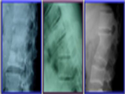 Triệu chứng: Bệnh nhân có thể sẽ gặp các dấu hiệu nhiễm trùng, nhiễm độc dài ngày như sốt dai dẳng ở mức độ vừa và nhẹ, sốt về chiều, mệt mỏi, kém ăn, xanh xao và đổ mồ hôi trộm. Những chỗ xương khớp bị vi khuẩn lao tấn công sẽ bị sưng to, nhưng không nóng và không đỏ như những bệnh viêm khớp cấp tính khác. Nếu nhìn được vào ổ khớp sẽ thấy màng hoạt dịch phù nề, loét mặt khớp, sụn có các nốt lao, củ lao và các ổ tiêu hủy tổ chức. Xem thêm: Những món ăn phòng bệnh trúng gió hiệu quả. Triệu chứng: Bệnh nhân có thể sẽ gặp các dấu hiệu nhiễm trùng, nhiễm độc dài ngày như sốt dai dẳng ở mức độ vừa và nhẹ, sốt về chiều, mệt mỏi, kém ăn, xanh xao và đổ mồ hôi trộm. Những chỗ xương khớp bị vi khuẩn lao tấn công sẽ bị sưng to, nhưng không nóng và không đỏ như những bệnh viêm khớp cấp tính khác. Nếu nhìn được vào ổ khớp sẽ thấy màng hoạt dịch phù nề, loét mặt khớp, sụn có các nốt lao, củ lao và các ổ tiêu hủy tổ chức. Xem thêm: Những món ăn phòng bệnh trúng gió hiệu quả.