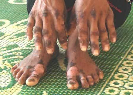 "Bệnh lạ" đã làm 7 người dân Quảng Ngãi tử vong trong đó hơn một nửa là trẻ em "Bệnh lạ" đã làm 7 người dân Quảng Ngãi tử vong trong đó hơn một nửa là trẻ em