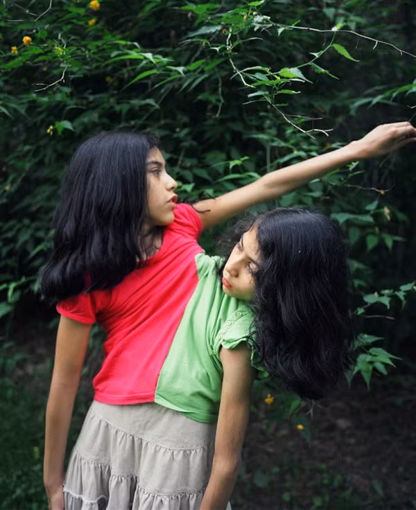 Bên cạnh đó, mẹ của cặp đôi này phải may những bộ quần áo đặc biệt để họ có thể mặc chung. Việc mặc quần áo cho cả hai cũng không hề dễ dàng. Xem thêm: Những hình ảnh thương tâm về căn bệnh 'lạ' ở Quảng Ngãi / Điểm danh một số người mắc hội chứng kỳ lạ "người sói" Bên cạnh đó, mẹ của cặp đôi này phải may những bộ quần áo đặc biệt để họ có thể mặc chung. Việc mặc quần áo cho cả hai cũng không hề dễ dàng. Xem thêm: Những hình ảnh thương tâm về căn bệnh 'lạ' ở Quảng Ngãi / Điểm danh một số người mắc hội chứng kỳ lạ "người sói"