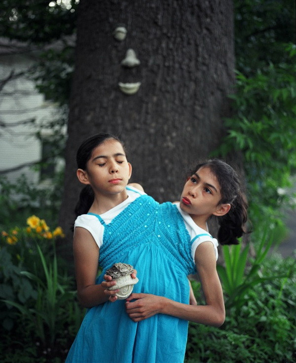 Cặp song sinh này luôn lạc quan và yêu đời. Xem thêm: Những hình ảnh thương tâm về căn bệnh 'lạ' ở Quảng Ngãi / Điểm danh một số người mắc hội chứng kỳ lạ "người sói" Cặp song sinh này luôn lạc quan và yêu đời. Xem thêm: Những hình ảnh thương tâm về căn bệnh 'lạ' ở Quảng Ngãi / Điểm danh một số người mắc hội chứng kỳ lạ "người sói"