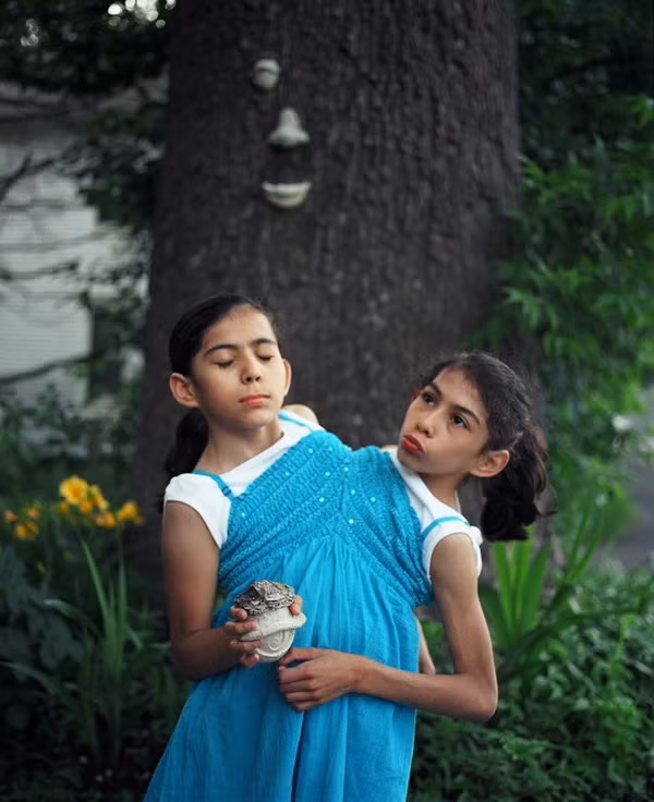 Cặp song sinh này luôn lạc quan và yêu đời. Xem thêm: Những hình ảnh thương tâm về căn bệnh 'lạ' ở Quảng Ngãi / Điểm danh một số người mắc hội chứng kỳ lạ "người sói" Cặp song sinh này luôn lạc quan và yêu đời. Xem thêm: Những hình ảnh thương tâm về căn bệnh 'lạ' ở Quảng Ngãi / Điểm danh một số người mắc hội chứng kỳ lạ "người sói"