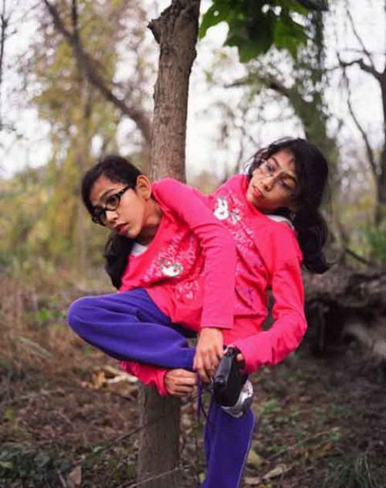 Cặp song sinh dính liền này có 2 đầu, 4 cánh tay và chỉ... 2 chân. Xem thêm: Những hình ảnh thương tâm về căn bệnh 'lạ' ở Quảng Ngãi / Điểm danh một số người mắc hội chứng kỳ lạ "người sói" Cặp song sinh dính liền này có 2 đầu, 4 cánh tay và chỉ... 2 chân. Xem thêm: Những hình ảnh thương tâm về căn bệnh 'lạ' ở Quảng Ngãi / Điểm danh một số người mắc hội chứng kỳ lạ "người sói"