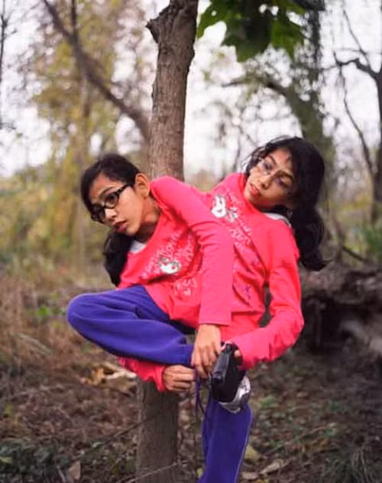 Cặp song sinh dính liền này có 2 đầu, 4 cánh tay và chỉ... 2 chân. Xem thêm: Những hình ảnh thương tâm về căn bệnh 'lạ' ở Quảng Ngãi / Điểm danh một số người mắc hội chứng kỳ lạ "người sói" Cặp song sinh dính liền này có 2 đầu, 4 cánh tay và chỉ... 2 chân. Xem thêm: Những hình ảnh thương tâm về căn bệnh 'lạ' ở Quảng Ngãi / Điểm danh một số người mắc hội chứng kỳ lạ "người sói"