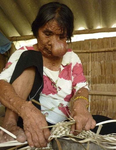 Bà Hiền với vô số bướu trên người - Ảnh: Hiền Trần