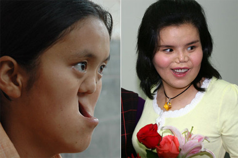 Trái - Wang Na năm 2006, trước khi phẫu thuật điều trị. Và Wang Na (phải) tháng 5/2010, sau khi trải qua 4 năm điều trị tại Bệnh viện nha khoa ở Tây An, Thiểm Tây, Trung Quốc. Ảnh: China Daily