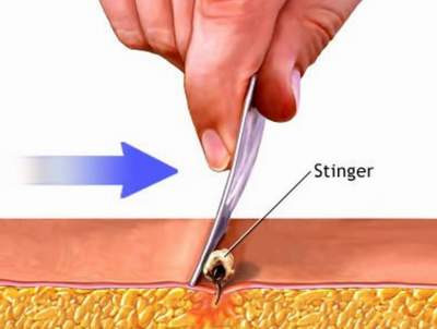 Khi bị ong đốt, dùng một vật nhọn như mũi dao, đầu kim... để khều kim chích ra. Khi bị ong đốt, dùng một vật nhọn như mũi dao, đầu kim... để khều kim chích ra.