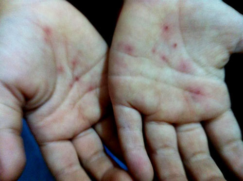 Bàn tay đầy vết bầm tím của cháu Vy được nghi do cô giáo đâm?