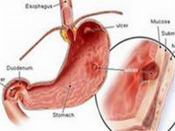 Ít vận động hàng ngày cũng làm cho lượng thức ăn tích lũy trong đường tiêu hóa do không tiêu hóa hết khiến nhu động ruột bị ảnh hưởng, lâu ngày có thể gây ra loét dạ dày, loét tá tràng... Ít vận động hàng ngày cũng làm cho lượng thức ăn tích lũy trong đường tiêu hóa do không tiêu hóa hết khiến nhu động ruột bị ảnh hưởng, lâu ngày có thể gây ra loét dạ dày, loét tá tràng...