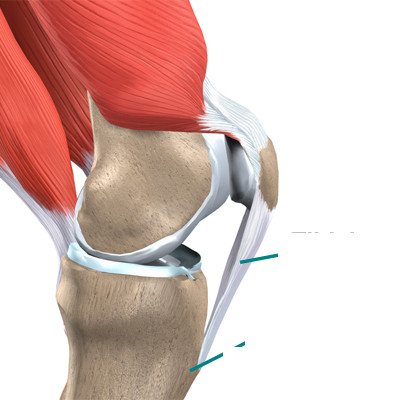 Tổn thương gân bánh chè. Tổn thương gân bánh chè.