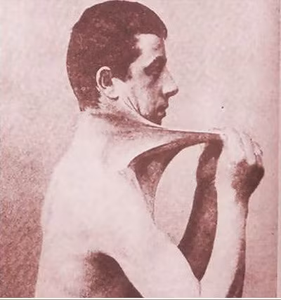 Hầu hết những người bị hội chứng Ehlers-Danlos được biết là có đột biến gen COL5A1 và COL5A2. Phỏng đoán có 1 trong 5.000 người bị hội chứng này. Có nhiều loại khác nhau và các biến thể của hội chứng này.