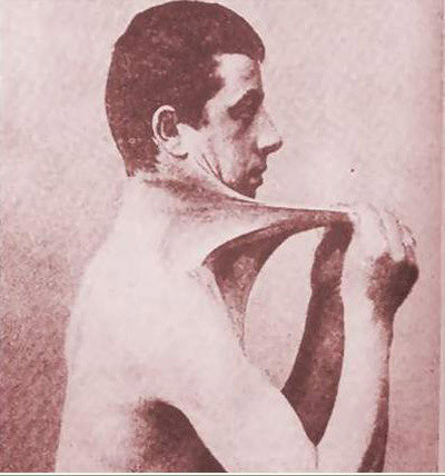 Hầu hết những người bị hội chứng Ehlers-Danlos được biết là có đột biến gen COL5A1 và COL5A2. Phỏng đoán có 1 trong 5.000 người bị hội chứng này. Có nhiều loại khác nhau và các biến thể của hội chứng này. Hầu hết những người bị hội chứng Ehlers-Danlos được biết là có đột biến gen COL5A1 và COL5A2. Phỏng đoán có 1 trong 5.000 người bị hội chứng này. Có nhiều loại khác nhau và các biến thể của hội chứng này.