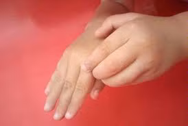 Hội chứng tay người ngoài hành tinh: những người bị hội chứng tay người ngoài hành tinh thường cảm thấy bàn tay mình di chuyển, với, cầm hoặc nắm cái gì đó ngoài tầm kiểm soát của bản thân.